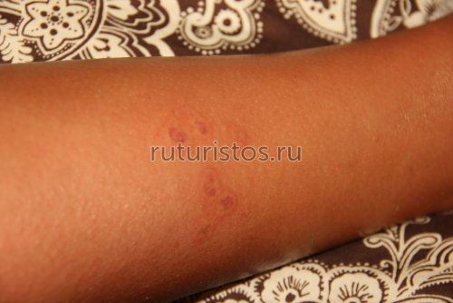 Покраснение кожи