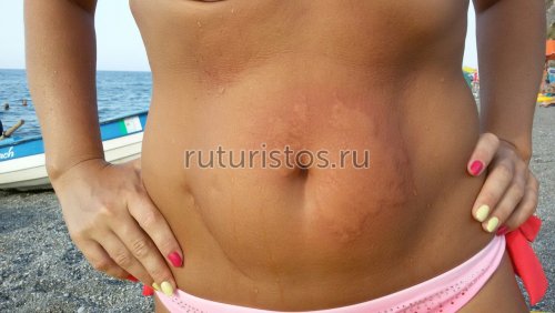 Реакция на ожог медузы
